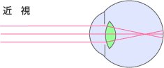 近視の図