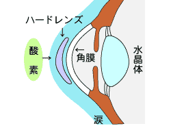 ハードレンズ